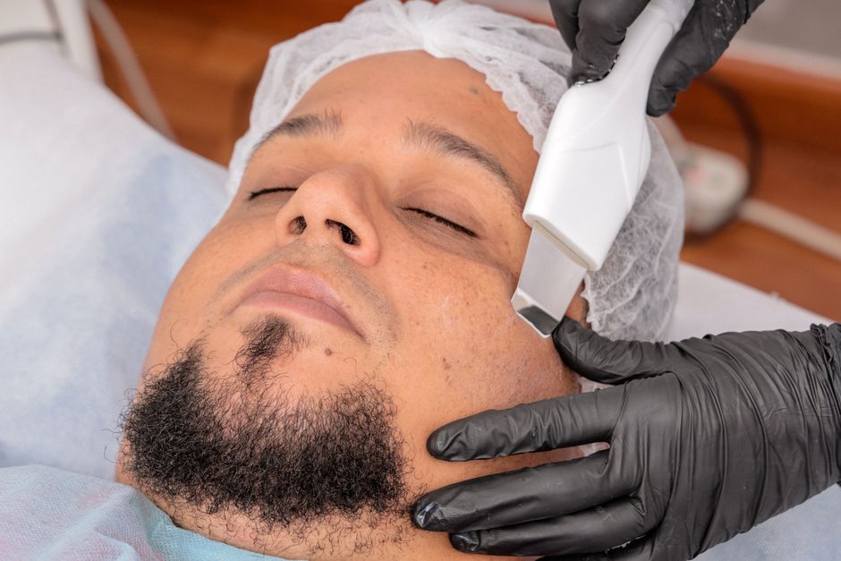 El tratamiento de peeling químico: todo lo que necesitas saber
